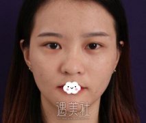 刘风卓眼整形修复案例：术后三个月果展示 width=