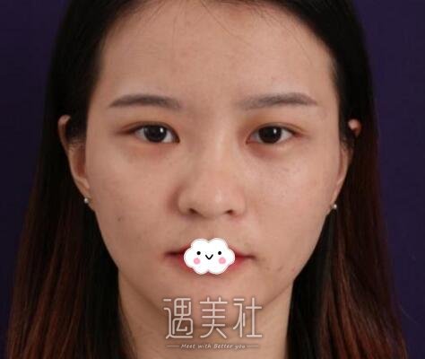 刘风卓,眼整形修复