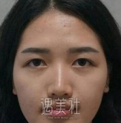 济南海峡整容失败案例：双眼皮恢复前后对比~ width=
