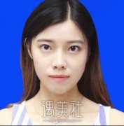 别筝隆鼻失败案例：手术前后恢复过程~ width=