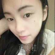 米兰柏羽卢尚兵案例|割双眼皮前后对比~ width=