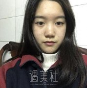 八大处滕利双眼皮案例|前后恢复对比图~ width=