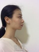 北京八大处靳小雷双眼皮案例：前后恢复过程对比~ width=