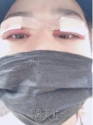 曹仁昌眼睛修复案例：前后恢复过程对比~ width=