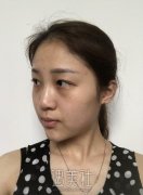 戴传昌做鼻子案例图片：前后恢复对比图~ width=