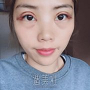 南京新街口康美整形医院怎么样？陈小剑双眼皮案例分享~ width=