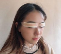 卢相勋做的好吗|卢相勋双眼皮案例对比~ width=