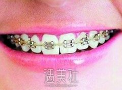 九院正畸价格多少钱，价格贵不贵? width=