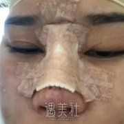 尤建军鼻部手术案例：前后过程恢复对比~ width=