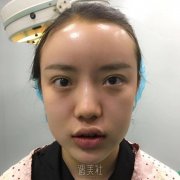 沈阳杏林张莹莹案例：自体脂肪填充额头分享~ width=