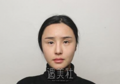 韩勋修复双眼皮案例 width=