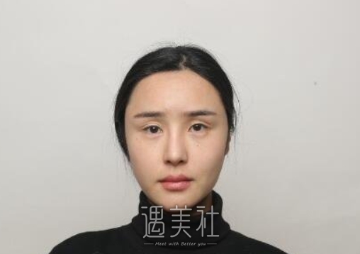 韩勋,修复双眼皮