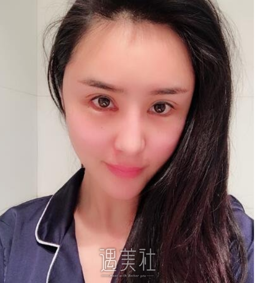 韩勋,修复双眼皮