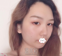 崔永言做的双眼皮很丑吗 案例 width=