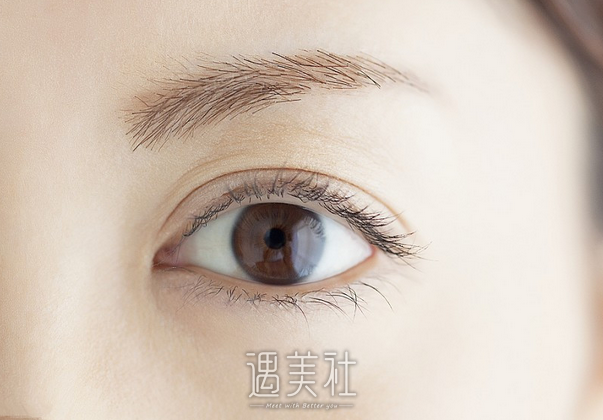 沈莺莺,双眼皮修复