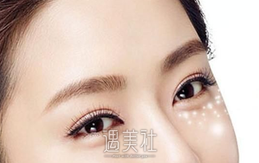 沈莺莺,双眼皮修复