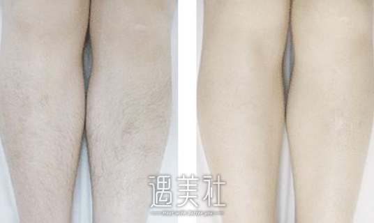 郑大一附属医院,脱毛