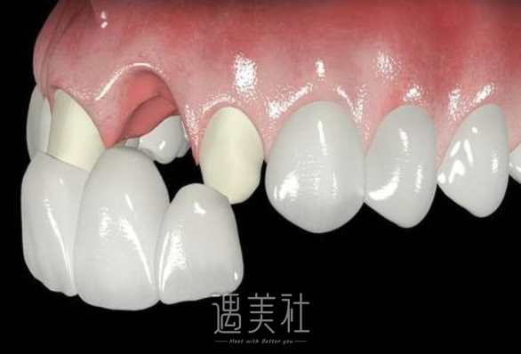 绵阳中医院,烤瓷牙