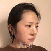 铜雀台周柯隆鼻案例?前后对比看出大问题~ width=
