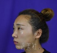 长沙亚韩失败案例?双眼皮恢复对比~ width=