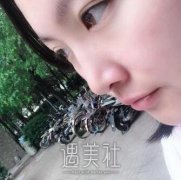 李圣利失败案例图片：隆鼻案例真实分享~ width=