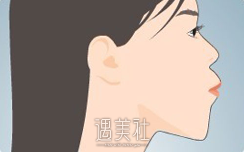 柳春明,凸嘴手术