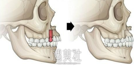 柳春明,凸嘴手术