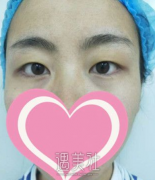 九院周慧芳双眼皮案例 width=