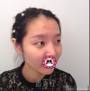 曹仁昌失败的眼睛案例：自然看不出一点的痕迹 width=