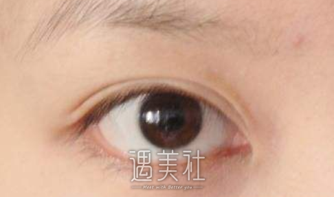 靳小雷,双眼皮修复
