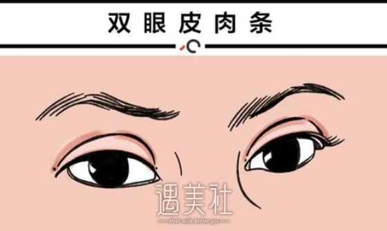 靳小雷,双眼皮修复