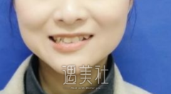 张一鸣正牙失败案例 终于可以开口大声笑了 width=