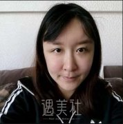 王海平双眼皮修复案例：术前术后恢复过程对比~ width=