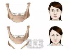 下颌角截骨术没问题吗?有同事想了解下~ width=