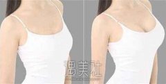 北京隆胸手术费用多少钱?比其他城市贵吗? width=