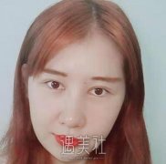 陈海良双眼皮修复案例展示|果令人惊讶! width=