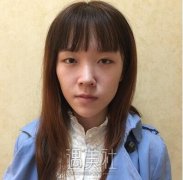 田孝臣隆鼻案例分享|果令人惊讶! width=