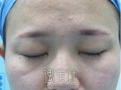 施悦医生双眼皮技术怎么样?热门案例分享~ width=