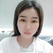 成都素美杨迪真有毁容案例?双眼皮案例一览~ width=