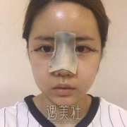 八大处周栩隆鼻技术怎么样?真实案例分享~ width=