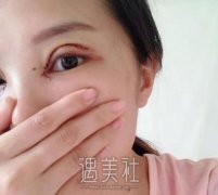 宁德韩美整形医院怎么样?双眼皮整形案例一览~ width=