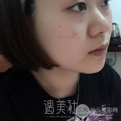 鼻头缩小手术对比图