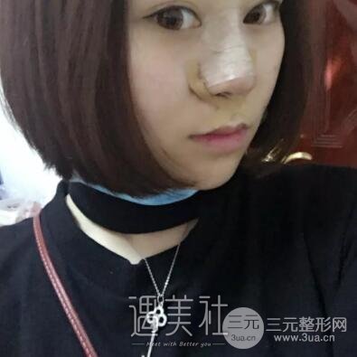 鼻头缩小手术对比图