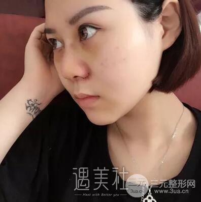 鼻头缩小手术对比图