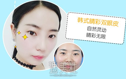汕头双眼皮修复价格大概多少钱？