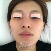 广州秀妍双眼皮整形技术怎么样?有失败案例吗? width=