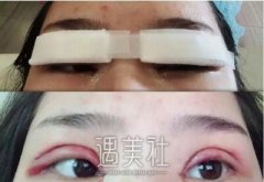 长沙亚韩整形美容医院双眼皮案例分享|果真惊人! width=