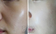 韩国灰姑娘美白是什么|韩国灰姑娘美白优势～ width=