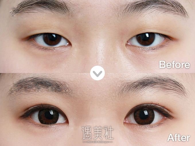 上海,九院,戴传昌,双眼皮修复