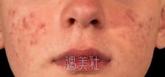 别让痘印毁了脸！解决痘印全攻略！ width=